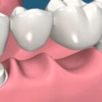 dental bridges in Leduc, AB