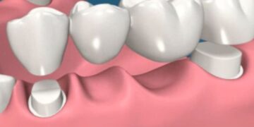 dental bridges in Leduc, AB