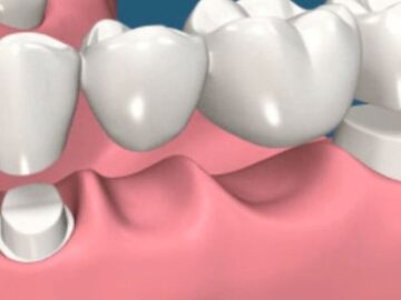 dental bridges in Leduc, AB