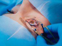 LASIK surgery