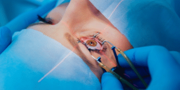LASIK surgery