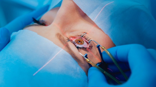 Beyond Clear Vision: Navigating LASIK Eye Surgery and Dry Eye