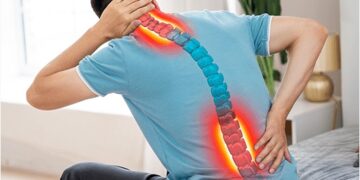 Spondylosis Treatment