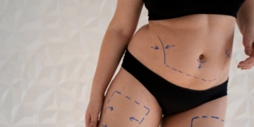 3D Liposuction Surgery In Bangalore